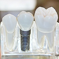 Quality Affordable Dental Services | Dental Implants