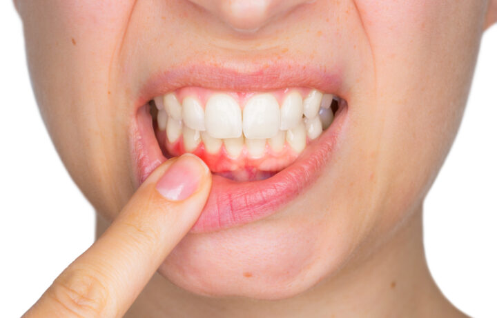 National Gum Care Month | ASH Dental Irvine
