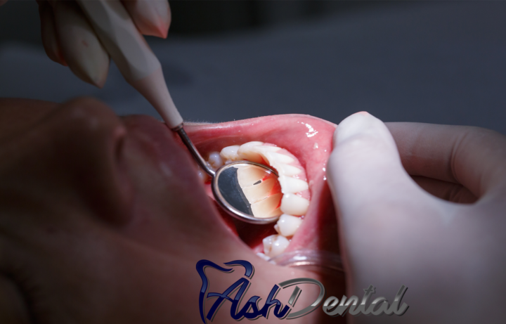 Gum Disease Awareness Month | ASH Dental Irvine